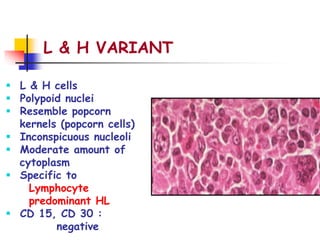 L & H VARIANT
 L & H cells
 Polypoid nuclei
 Resemble popcorn
kernels (popcorn cells)
 Inconspicuous nucleoli
 Moderate amount of
cytoplasm
 Specific to
Lymphocyte
predominant HL
 CD 15, CD 30 :
negative
 