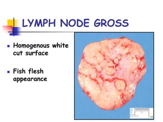 LYMPH NODE GROSS
 Homogenous white
cut surface
 Fish flesh
appearance
 
