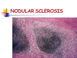 NODULAR SCLEROSIS
 