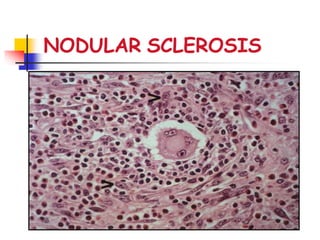 NODULAR SCLEROSIS
 