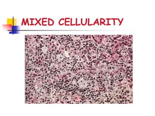MIXED CELLULARITY
 