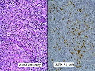 Mixed cellularity, CD15+ RS cells
 