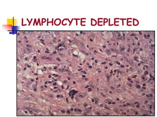 LYMPHOCYTE DEPLETED
 