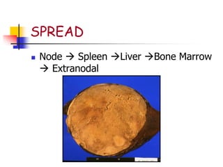 SPREAD
 Node  Spleen Liver Bone Marrow
 Extranodal
 