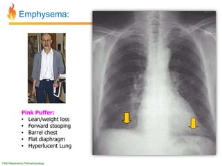 Pathology of Respiratory System Disorders | PPTX