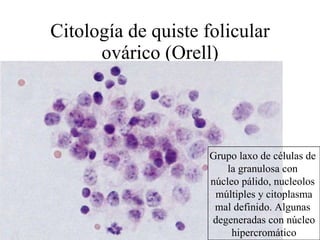 Citología de quiste folicular ovárico (Orell) Grupo laxo de células de  la granulosa con  núcleo pálido, nucleolos  múltiples y citoplasma mal definido. Algunas  degeneradas con núcleo hipercromático 