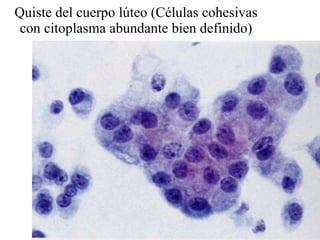 Quiste del cuerpo lúteo (Células cohesivas con citoplasma abundante bien definido) 