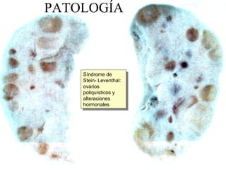 PATOLOGÍA Síndrome de Stein- Leventhal: ovarios poliquísticos y alteraciones hormonales 