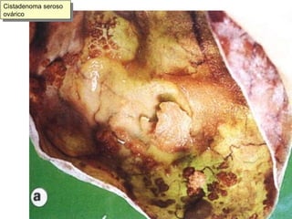 Cistadenoma seroso ovárico 