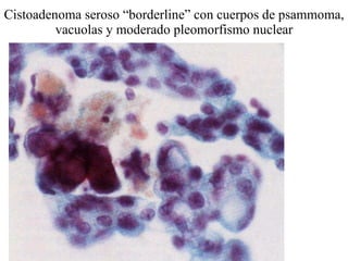 Cistoadenoma seroso “borderline” con cuerpos de psammoma, vacuolas y moderado pleomorfismo nuclear 