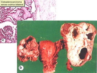 Cistoadenocarcinoma seroso ovárico bilateral 