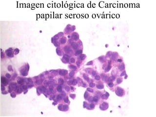 Imagen citológica de Carcinoma papilar seroso ovárico 