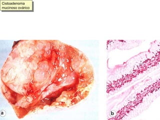 Cistoadenoma mucinoso ovárico 