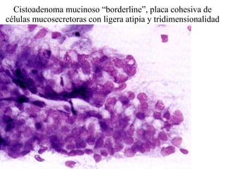 Cistoadenoma mucinoso “borderline”, placa cohesiva de células mucosecretoras con ligera atipia y tridimensionalidad 