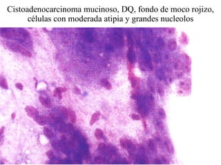 Cistoadenocarcinoma mucinoso, DQ, fondo de moco rojizo, células con moderada atipia y grandes nucleolos 