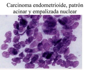 Carcinoma endometrioide, patrón acinar y empalizada nuclear 