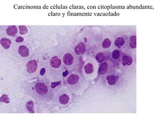 Carcinoma de células claras, con citoplasma abundante, claro y finamente vacuolado 
