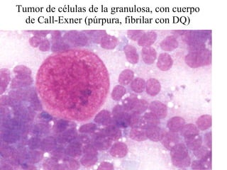 Tumor de células de la granulosa, con cuerpo de Call-Exner (púrpura, fibrilar con DQ) 