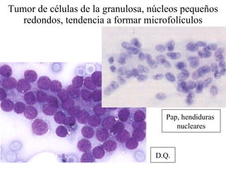 Tumor de células de la granulosa, núcleos pequeños redondos, tendencia a formar microfolículos D.Q. Pap, hendiduras  nucleares 