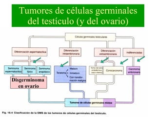 Tumores de células germinales del testículo (y del ovario) Disgerminoma  en ovario 