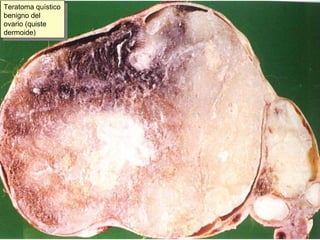 Teratoma quístico benigno del ovario (quiste dermoide) 
