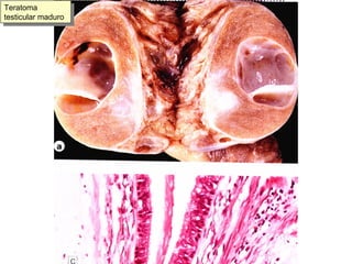 Teratoma testicular maduro 