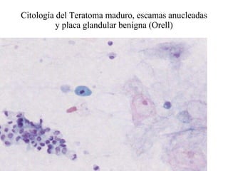 Citología del Teratoma maduro, escamas anucleadas y placa glandular benigna (Orell) 