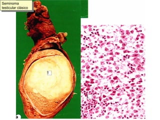 Seminoma testicular clásico 