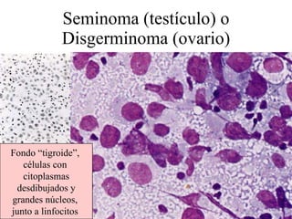 Seminoma (testículo) o Disgerminoma (ovario) Fondo “tigroide”,  células con  citoplasmas desdibujados y grandes núcleos,  junto a linfocitos  
