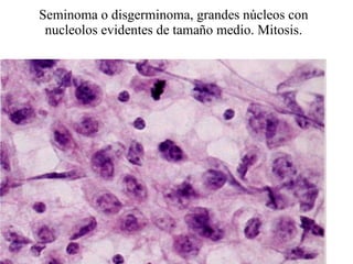 Seminoma o disgerminoma, grandes núcleos con nucleolos evidentes de tamaño medio. Mitosis. 