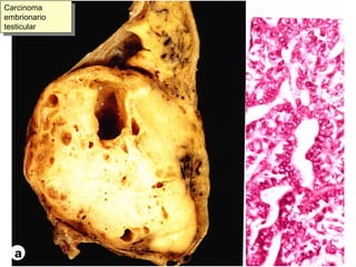 Carcinoma embrionario testicular 