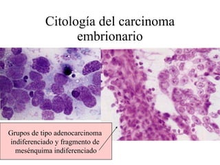 Citología del carcinoma embrionario Grupos de tipo adenocarcinoma  indiferenciado y fragmento de  mesénquima indiferenciado 