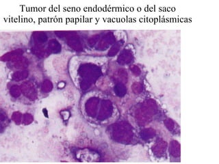 Tumor del seno endodérmico o del saco vitelino, patrón papilar y vacuolas citoplásmicas 