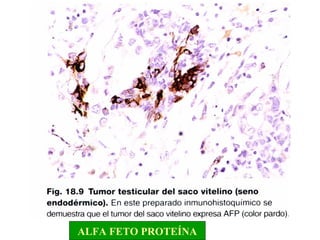 ALFA FETO PROTEÍNA 