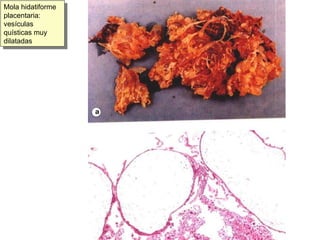 Mola hidatiforme placentaria: vesículas quísticas muy dilatadas 