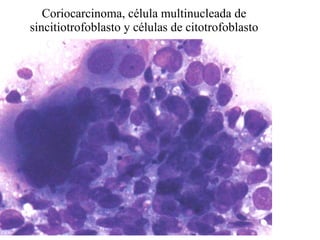 Coriocarcinoma, célula multinucleada de sincitiotrofoblasto y células de citotrofoblasto 