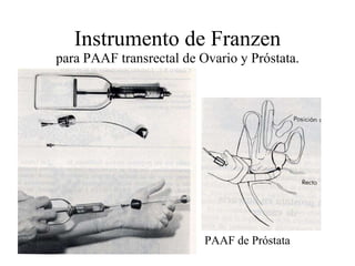 Instrumento de Franzen para PAAF transrectal de Ovario y Próstata. PAAF de Próstata 