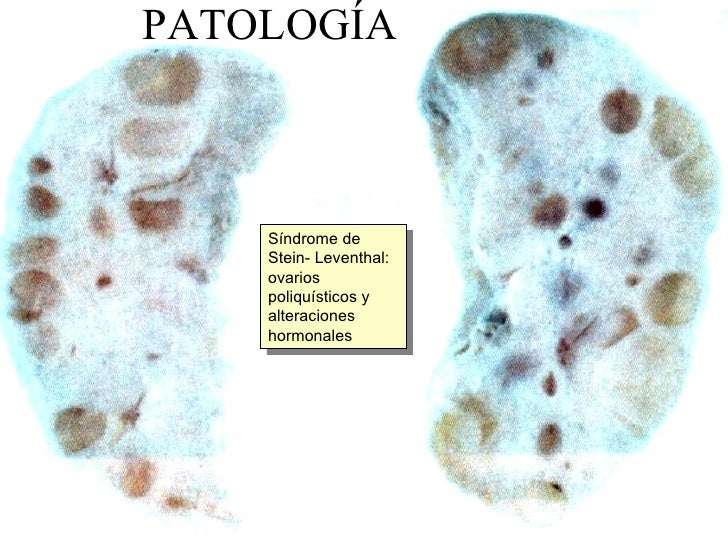 A Sindrome De Stein Leventhal Tambem Conhecida Como