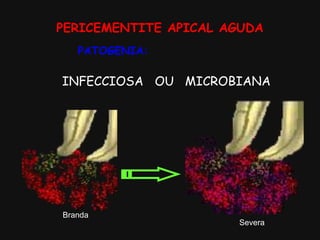 PERICEMENTITE APICAL AGUDA
INFECCIOSA OU MICROBIANA
Branda
Severa
PATOGENIA:
 