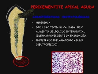 PERICEMENTITE APICAL AGUDA
CARACTERÍSTICAS HISTPATOLÓGICAS
• HIPEREMIA
• DIVULSÃO TECIDUAL CAUSADA PELO
AUMENTO DE LÍQUIDO INTERSISTIAL
(EDEMA) PROVENIENTE DA EXSUDAÇÃO.
• INFILTRADO INFLAMATÓRIO AGUDO
(NEUTROFÍLICO)
 