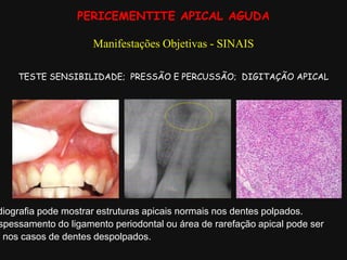 PERICEMENTITE APICAL AGUDA
Manifestações Objetivas - SINAIS
diografia pode mostrar estruturas apicais normais nos dentes polpados.
spessamento do ligamento periodontal ou área de rarefação apical pode ser
a nos casos de dentes despolpados.
TESTE SENSIBILIDADE; PRESSÃO E PERCUSSÃO; DIGITAÇÃO APICAL
 