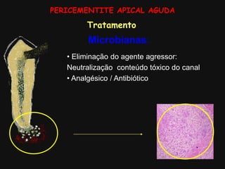 PERICEMENTITE APICAL AGUDA
Tratamento
Microbianas:
• Eliminação do agente agressor:
Neutralização conteúdo tóxico do canal
• Analgésico / Antibiótico
 
