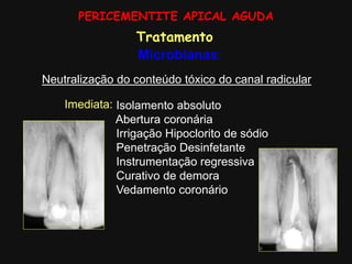 PERICEMENTITE APICAL AGUDA
Tratamento
Microbianas:
Neutralização do conteúdo tóxico do canal radicular
Imediata: Isolamento absoluto
Abertura coronária
Irrigação Hipoclorito de sódio
Penetração Desinfetante
Instrumentação regressiva
Curativo de demora
Vedamento coronário
 