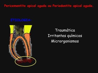 ETIOLOGIA:
Pericementite apical aguda ou Periodontite apical aguda.
Traumática
Irritantes químicos
Microrganismos
 