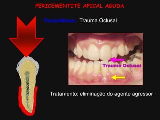 PERICEMENTITE APICAL AGUDA
Traumáticos: Trauma Oclusal
Tratamento: eliminação do agente agressor
 