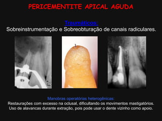 PERICEMENTITE APICAL AGUDA
Manobras operatórias heterogênicas:
Restaurações com excesso na oclusal, dificultando os movimentos mastigatórios.
Uso de alavancas durante extração, pois pode usar o dente vizinho como apoio.
Traumáticos:
Sobreinstrumentação e Sobreobturação de canais radiculares.
 
