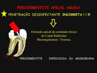 PERICEMENTITE APICAL AGUDA
PENETRAÇÃO DESINFECTANTE INCORRETA ! ! !!!
PERICEMENTITE INFECCIOSA OU MICROBIANA
Extrusão apical do conteúdo tóxico
do Canal Radicular.
Microrganismos / Toxinas.
 