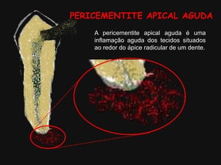 PERICEMENTITE APICAL AGUDA
A pericementite apical aguda é uma
inflamação aguda dos tecidos situados
ao redor do ápice radicular de um dente.
 