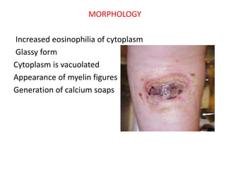 MORPHOLOGY
Increased eosinophilia of cytoplasm
Glassy form
Cytoplasm is vacuolated
Appearance of myelin figures
Generation of calcium soaps
 