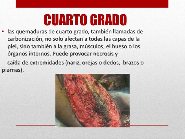 Beaufiful Quemadura Cuarto Grado Pictures >> Quemaduras Primeros ... Beaufiful Quemadura Cuarto Grado Pictures >> Quemaduras Primeros ...